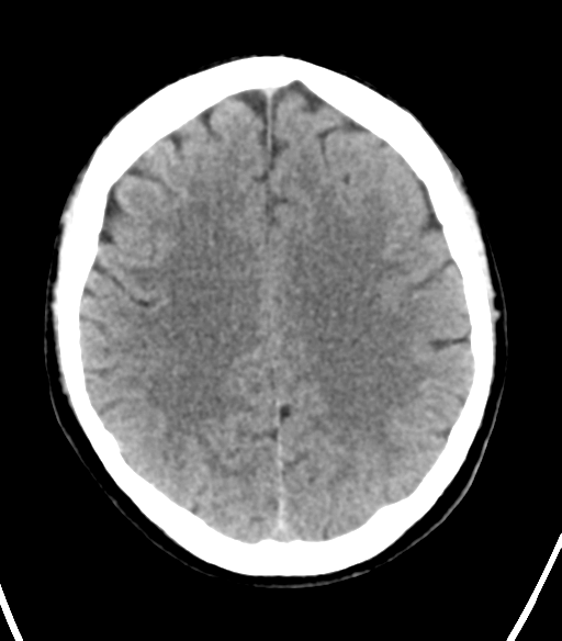 File:Cerebellar hemorrhage (Radiopaedia 37000-38669 Axial non-contrast 27).png