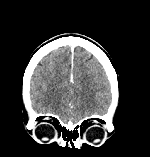 Cerebellar metastases - colorectal adenocarcinoma (Radiopaedia 40947-43652 Coronal C+ 23).png