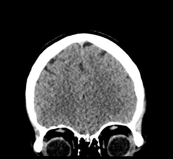 Cerebellar metastases - colorectal adenocarcinoma (Radiopaedia 40947-43652 Coronal non-contrast 26).png