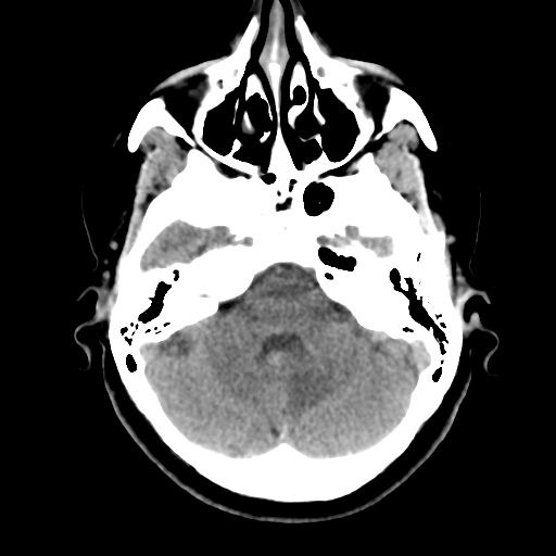 Cerebellar metastasis (cystic appearance) (Radiopaedia 41395-44258 Axial non-contrast 15).png
