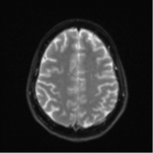 Cerebellar metastasis - adenocarcinoma lung (Radiopaedia 63184-71715 Axial DWI 23).png