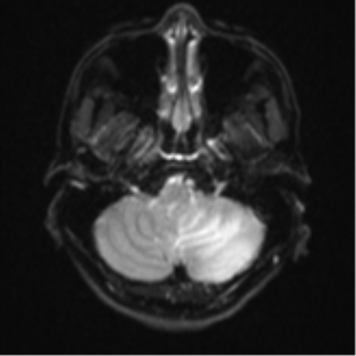 Cerebellar metastasis - adenocarcinoma lung (Radiopaedia 63184-71715 Axial DWI 5).png