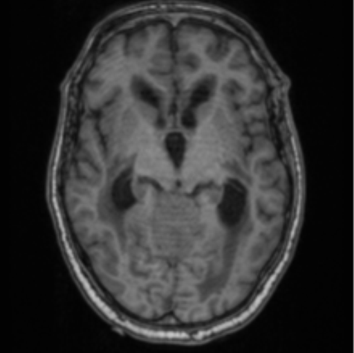Cerebellar metastasis from lung adenocarcinoma (Radiopaedia 86690-102829 Axial T1 38).png