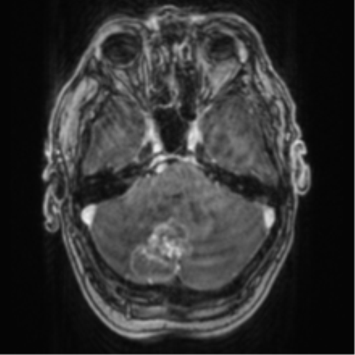 Cerebellar metastasis from lung adenocarcinoma (Radiopaedia 86690-102829 Axial T1 C+ 23).png