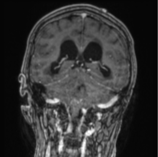 Cerebellar metastasis from lung adenocarcinoma (Radiopaedia 86690-102829 Coronal T1 C+ 42).png
