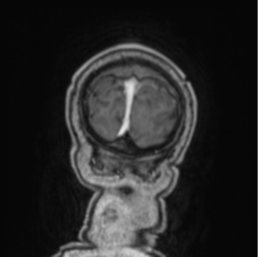 Cerebellar metastasis from lung adenocarcinoma (Radiopaedia 86690-102829 Coronal T1 C+ 7).png