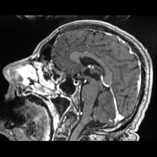 Cerebellar metastasis of pulmonary adenocarcinoma, cavernous venous malformation, and developmental venous anomaly (Radiopaedia 85827-101661 Sagittal T1 C+ 51).jpg