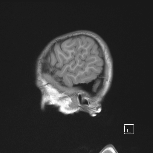 Cerebellar stroke (Radiopaedia 32202-33150 Sagittal T1 C+ 48).png