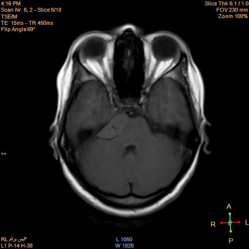 File:Cerebellopontine angle meningioma (Radiopaedia 22488-22525 Axial T1 5).jpg
