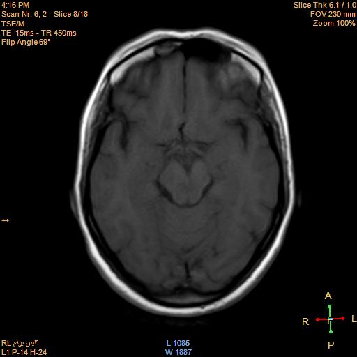 File:Cerebellopontine angle meningioma (Radiopaedia 22488-22525 Axial T1 7).jpg
