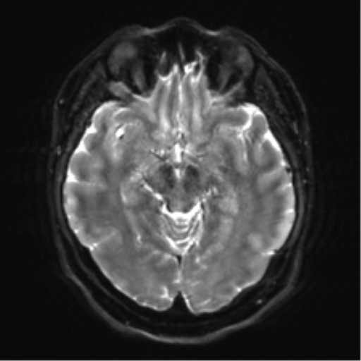 Cerebellopontine angle meningioma (Radiopaedia 48434-53348 Axial DWI 16).png