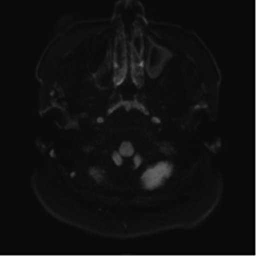 Cerebellopontine angle meningioma (Radiopaedia 48434-53348 Axial DWI 38).png