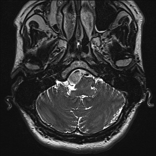 File:Cerebellopontine angle meningioma (Radiopaedia 72983-83680 Axial FIESTA 9).jpg