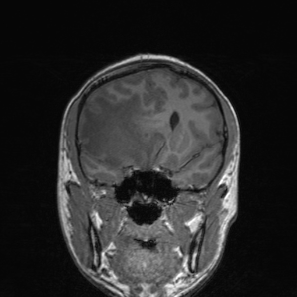 File:Cerebral abscess (Radiopaedia 24212-24478 Coronal T1 85).jpg