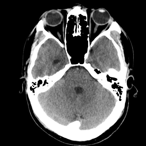 Cerebral abscess (Radiopaedia 29451-29919 Axial non-contrast 15).jpg