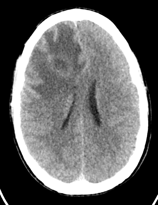Cerebral abscess (Radiopaedia 60342-68008 Axial non-contrast 33).png