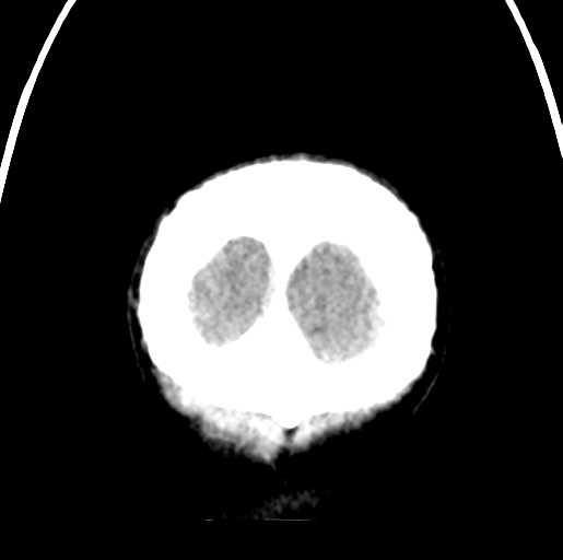 Cerebral abscess (Radiopaedia 60342-68008 Coronal non-contrast 62).png