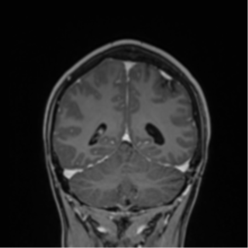 File:Cerebral abscess (Radiopaedia 60342-68009 H 11).png