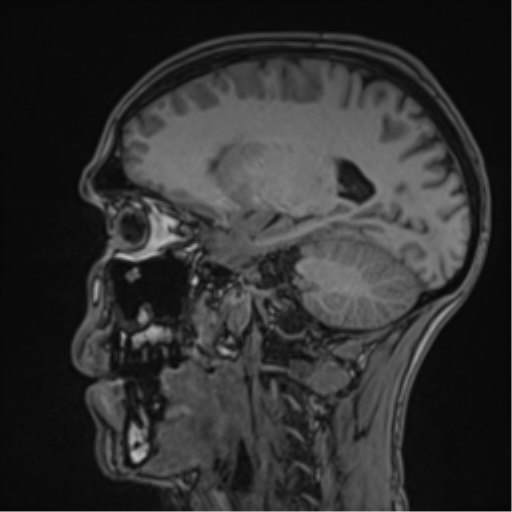 Cerebral abscess (Radiopaedia 60342-68009 Sagittal T1 23).png