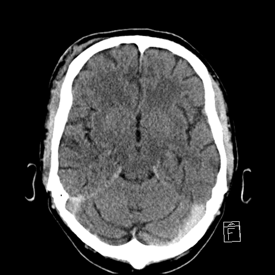 File:Cerebral abscess with ventriculitis (Radiopaedia 78965-91877 A 19).jpg