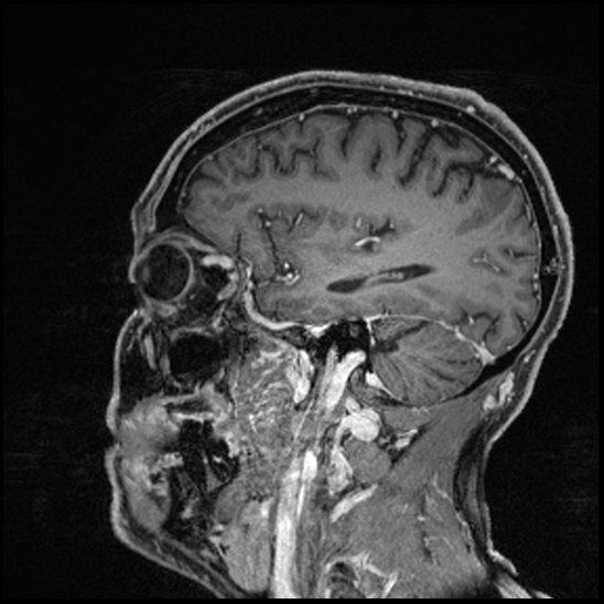 Cerebral abscess with ventriculitis (Radiopaedia 78965-91878 Sagittal T1 C+ 129).jpg