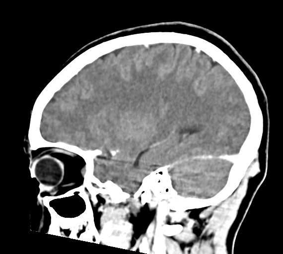 Cerebral abscesses (Radiopaedia 70458-80568 Sagittal Contrast 39).jpg
