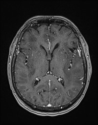 Cerebral amyloid angiopathy-related inflammation (Radiopaedia 58270-65377 Axial T1 C+ fat sat 74).jpg