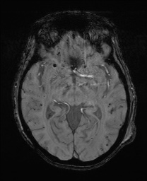 File:Cerebral amyloid angiopathy-related inflammation (Radiopaedia 74836-85849 Axial SWI 33).jpg