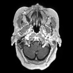 File:Cerebral amyloid angiopathy (Radiopaedia 29129-29518 Axial T1 C+ 22).jpg