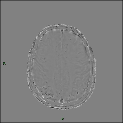 Cerebral amyloid angiopathy (Radiopaedia 77506-89664 H 74).jpg