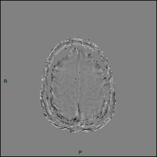 File:Cerebral amyloid angiopathy (Radiopaedia 77506-89664 H 89).jpg