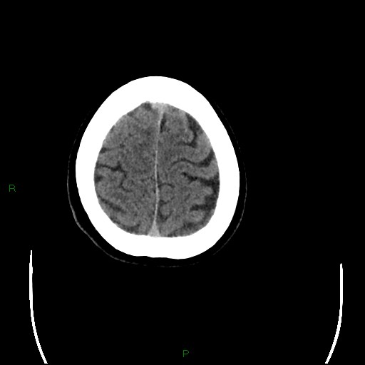 Cerebral amyloid angiopathy (Radiopaedia 77506-89665 Axial non-contrast 97).jpg