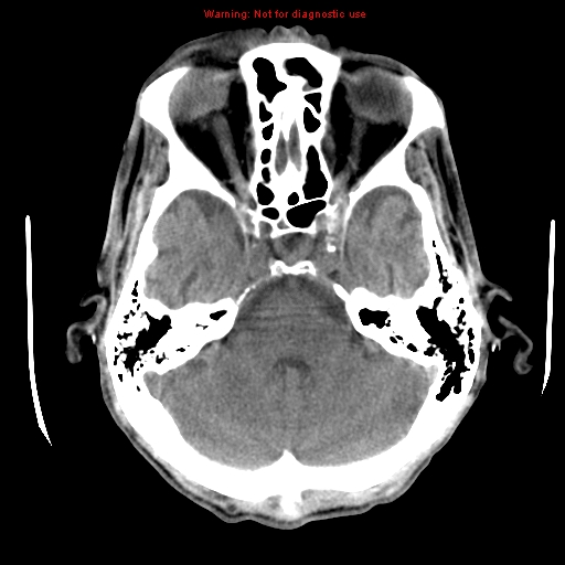 File:Cerebral and orbital tuberculomas (Radiopaedia 13308-13310 Axial non-contrast 8).jpg