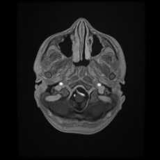 File:Cerebral and spinal tuberculosis (Radiopaedia 90489-107837 Axial T1 C+ 38).jpg