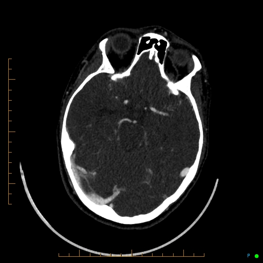 Cerebral arteriovenous malformation (AVM) (Radiopaedia 78162-90706 Axial CTA 111).jpg