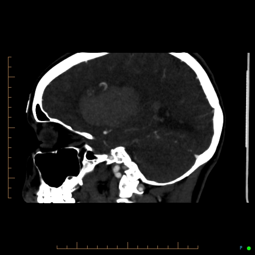Cerebral arteriovenous malformation (AVM) (Radiopaedia 78162-90706 Sagittal CTA 31).jpg