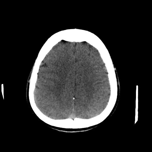 Cerebral arteriovenous malformation (Radiopaedia 28518-28759 Axial non-contrast 55).jpg