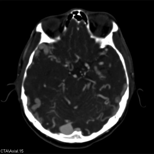 Cerebral arteriovenous malformation (Radiopaedia 28518-28759 B 15).jpg