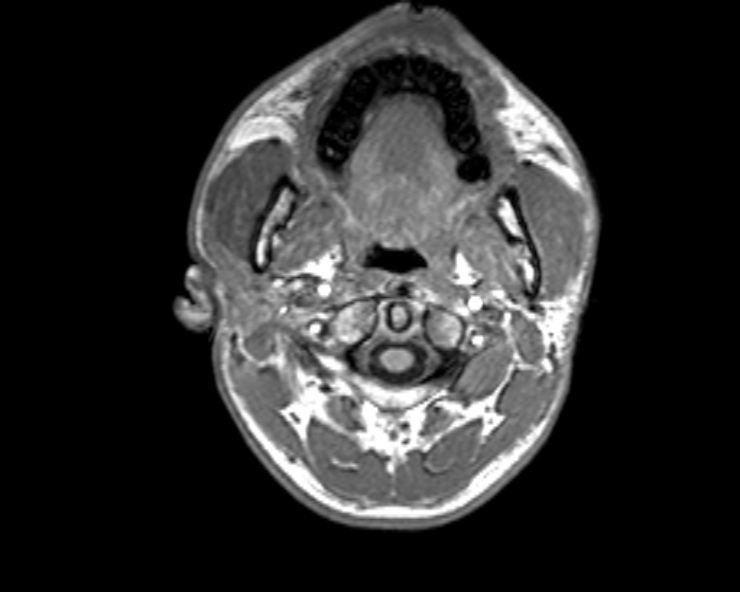 Cerebral arteriovenous malformation (Radiopaedia 30198-30813 Axial T1 55).jpg