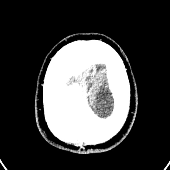 Cerebral arteriovenous malformation (Radiopaedia 37182-39012 Axial non-contrast 45).jpg