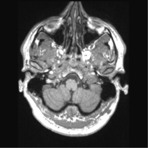 File:Cerebral arteriovenous malformation (Radiopaedia 39259-41506 Axial T1 13).png