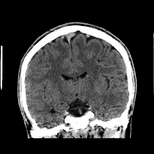 Cerebral arteriovenous malformation (Radiopaedia 61964-70028 Coronal non-contrast 31).jpg