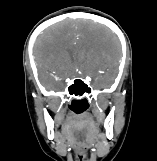 Cerebral arteriovenous malformation (Radiopaedia 73830-84645 C 39).jpg