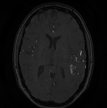 Cerebral arteriovenous malformation (Radiopaedia 74411-85654 Axial MRA 84).jpg