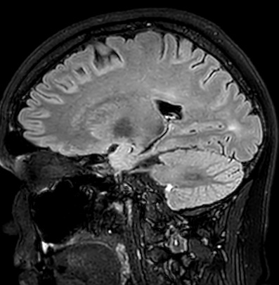 Cerebral arteriovenous malformation (Radiopaedia 74411-85746 Sagittal FLAIR 42).jpg