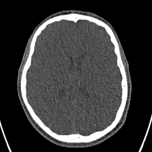 Cerebral arteriovenous malformation (Radiopaedia 78188-90746 Axial non-contrast 105).jpg