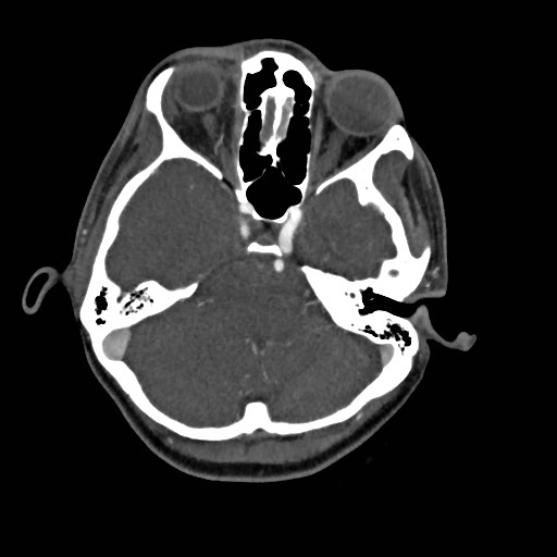 File:Cerebral arteriovenous malformation (Radiopaedia 79677-92888 A 10).jpg