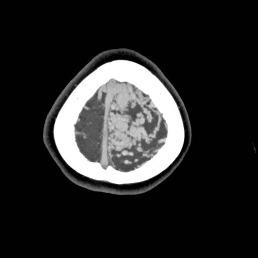 File:Cerebral arteriovenous malformation (Radiopaedia 79677-92888 A 56).jpg