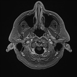 File:Cerebral arteriovenous malformation (Radiopaedia 84015-99245 Axial T1 C+ 20).jpg