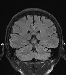 File:Cerebral arteriovenous malformation (Radiopaedia 84015-99245 Coronal FLAIR 21).jpg